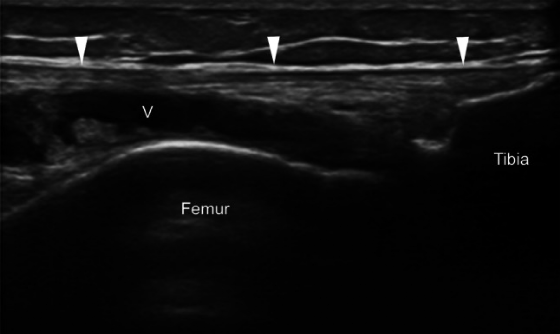 髂胫束综合症超声图像