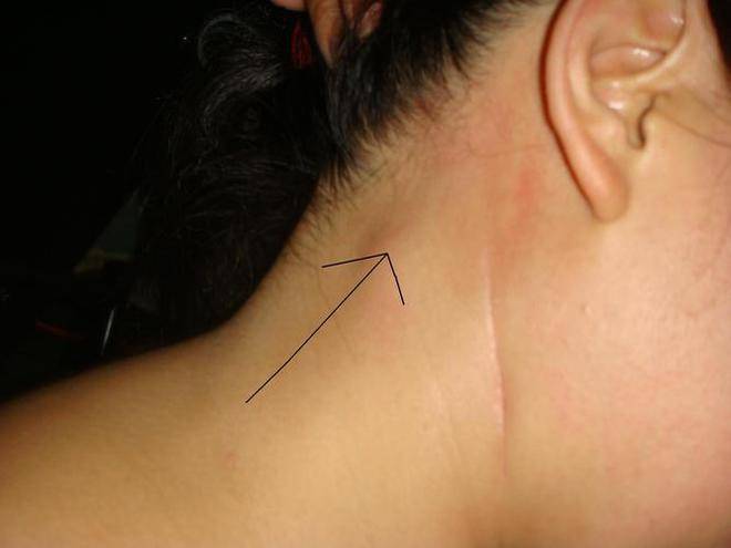 原创体内有癌脖子先知脖子出现3个异常或是癌症在靠近