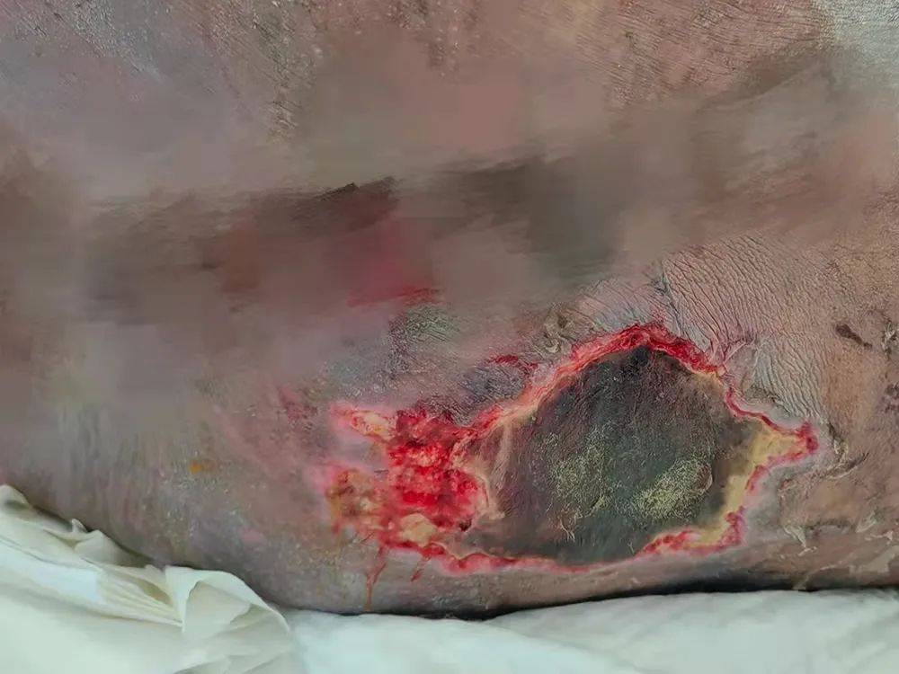 原创减重手术丨阳江第一胖龙哥终于可以向左转右臀大窟窿震惊在场医生