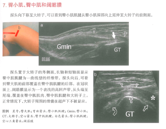髂胫束综合症超声图像