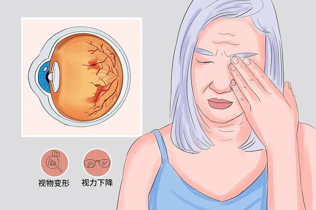 眼底血管造影,oct等检查,第三眼底病外科中心主任李忠恩根据检查结果