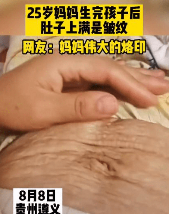 产后肚皮又黑又皱不能直视腹壁成形可以改善吗