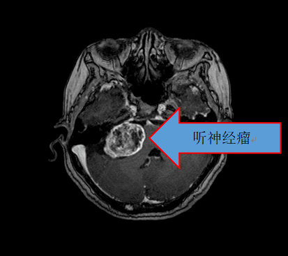 高尚超声神经纤维瘤病1例