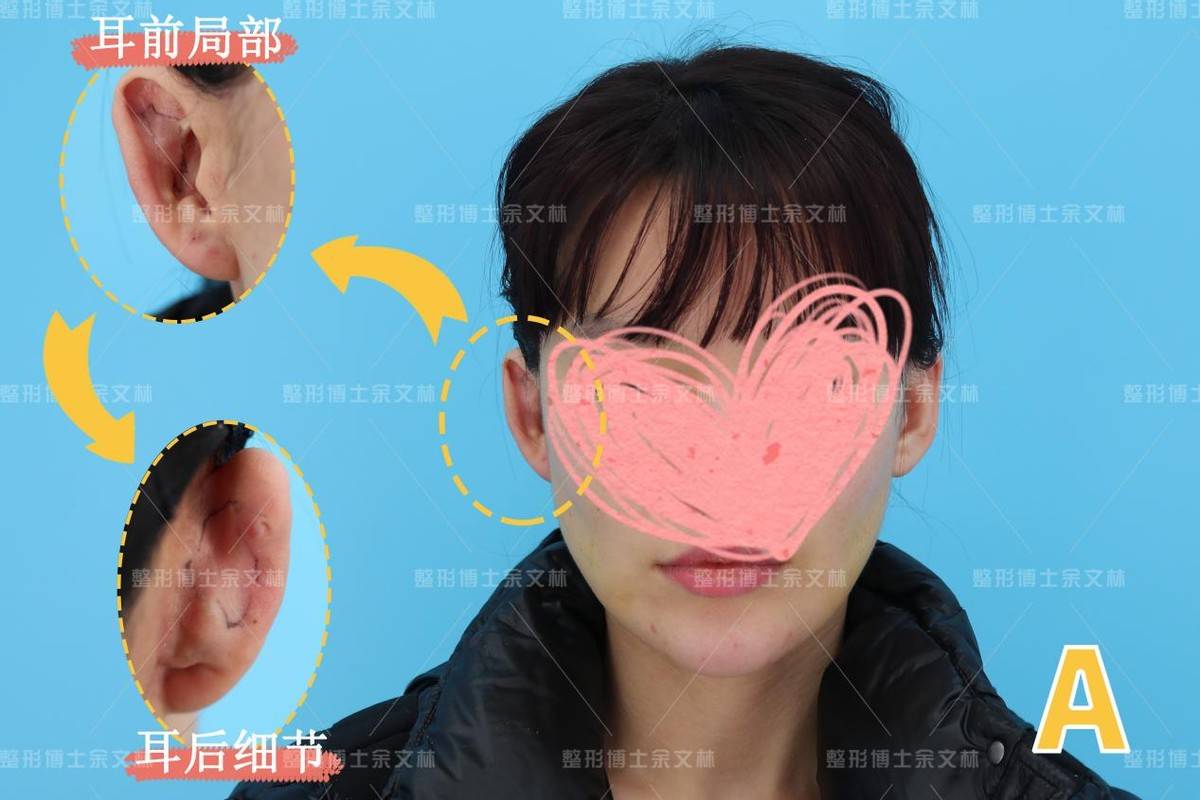 整形医院鼻部手术价格_整形医院鼻部打版是什么意思_医院鼻部整形
