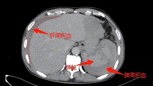 胡金秋脾破裂手术医生告诉你什么是脾破裂严不严重