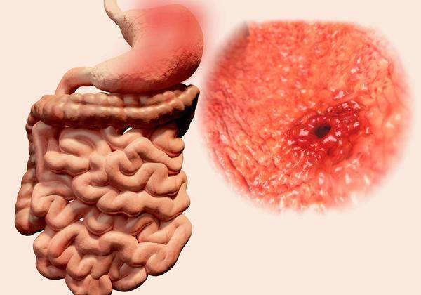 原創腸息肉是良性腫瘤它會變成腸癌嗎答案竟不出所料