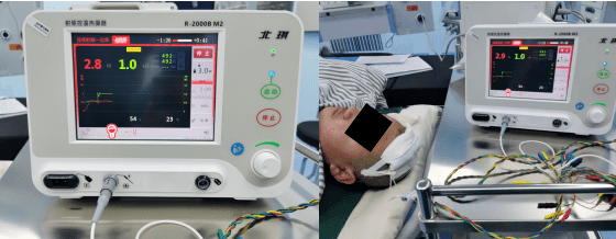 河南三博脑科医院功能神经外科成功开展立体定向颅内电极技术诊治癫痫