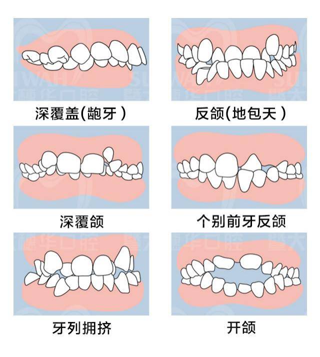 孩子是否有错颌畸形?家长看过来~暨大穗华口腔正畸专家教你几招
