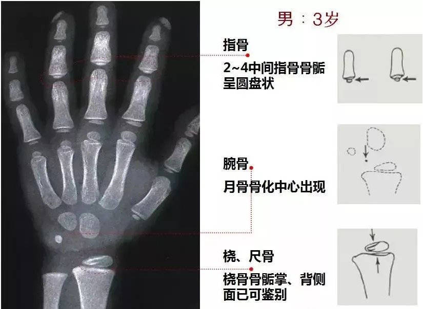 儿童手部骨骼发育图图片