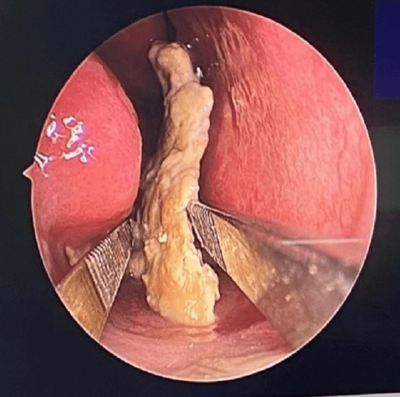 女子鼻腔内长结石,罪魁祸首竟是多年前塞入鼻内的一粒串珠?