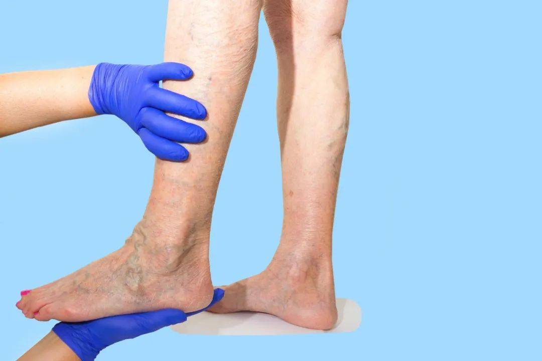 下肢_血管_风险