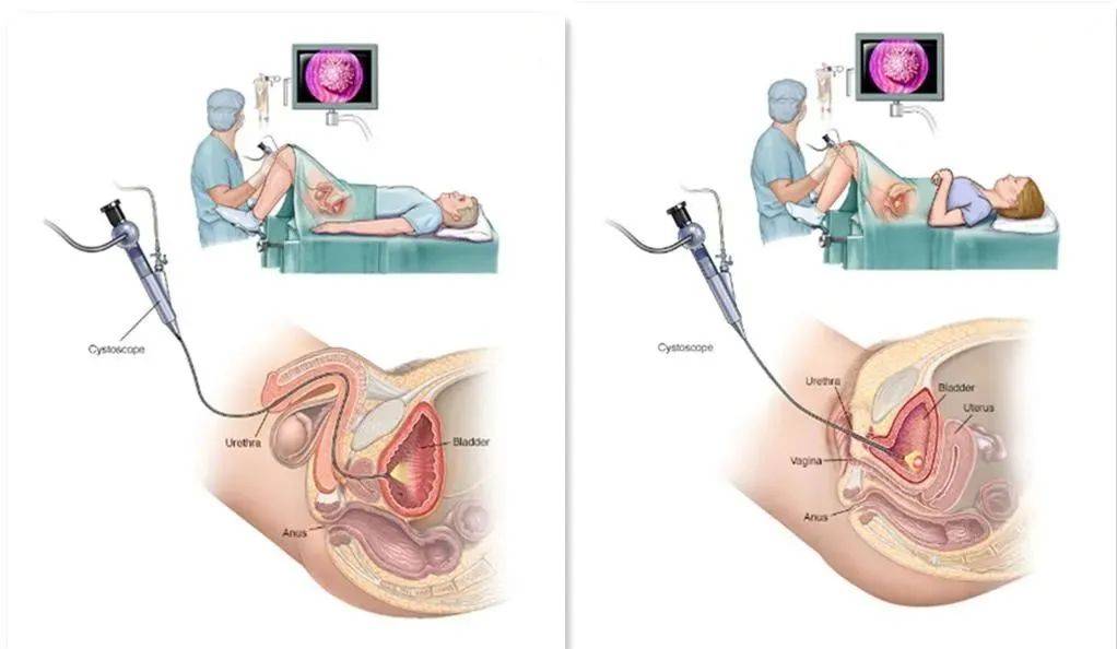 女性手术 膀胱镜图片