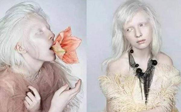 一个人有白化病,是和他的亲戚以及父母的遗传染色体有关系的,白化病是