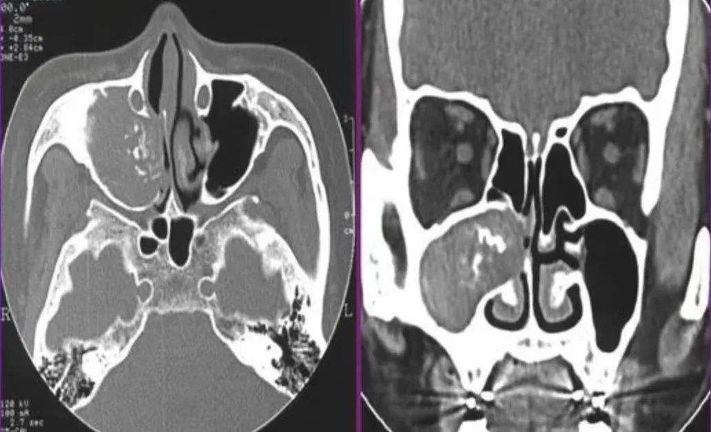 反复头痛鼻腔异味警惕真菌性鼻窦炎