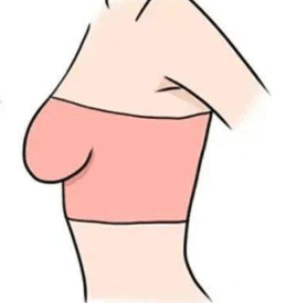 女性的胸部有哪几种形状