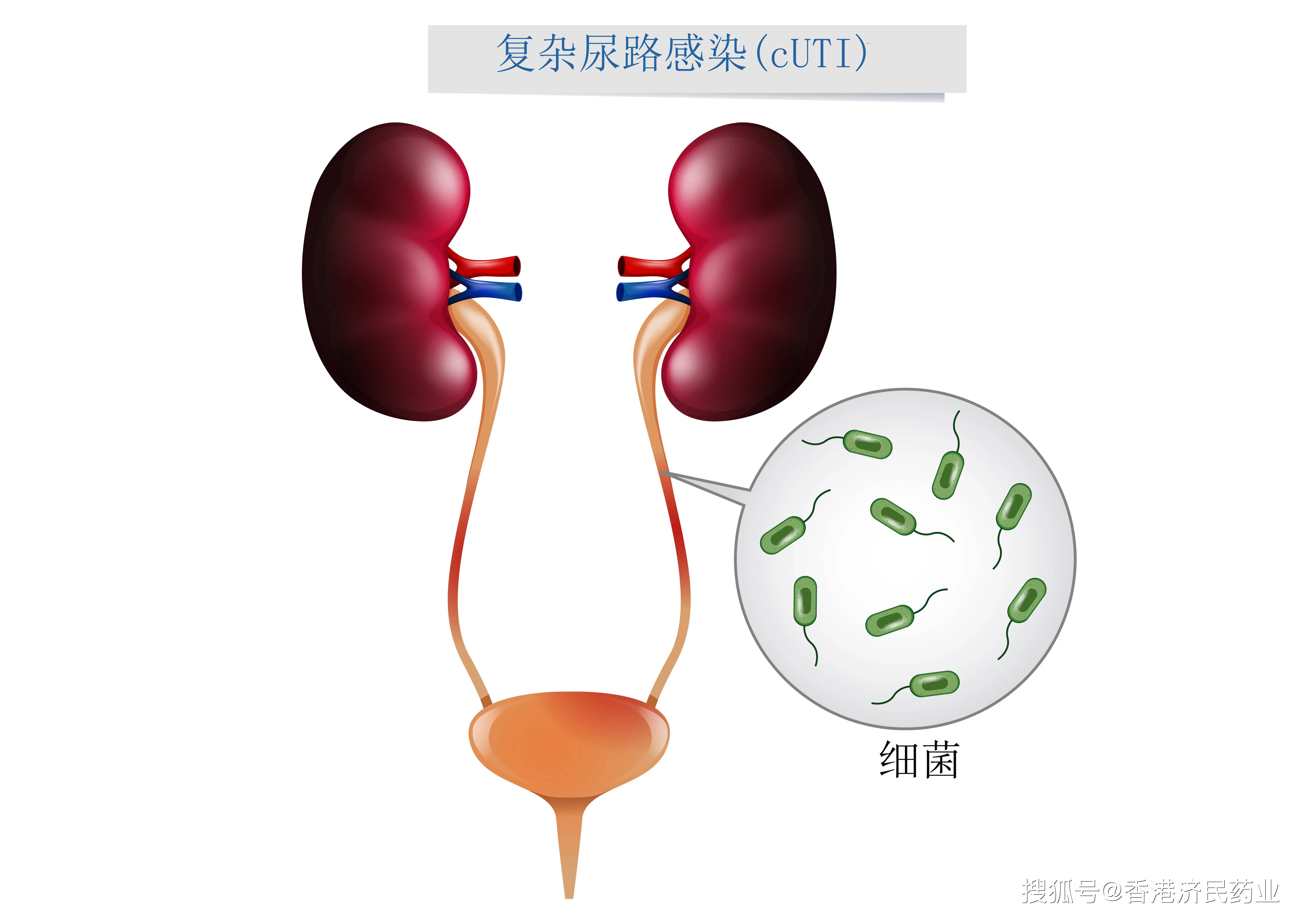 zerbaxa获得fda批准用于复杂的小儿腹内尿路感染
