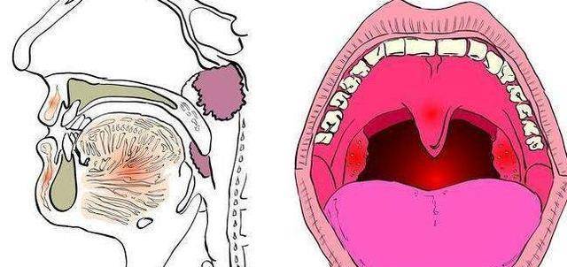 但是不建议儿童切除扁桃体,因为儿童正在处于一个生长发育期,免疫力