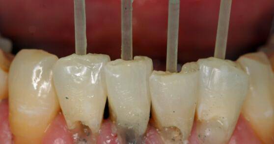 你这样刷牙,当心把牙齿刷断_颈部_牙刷_方式