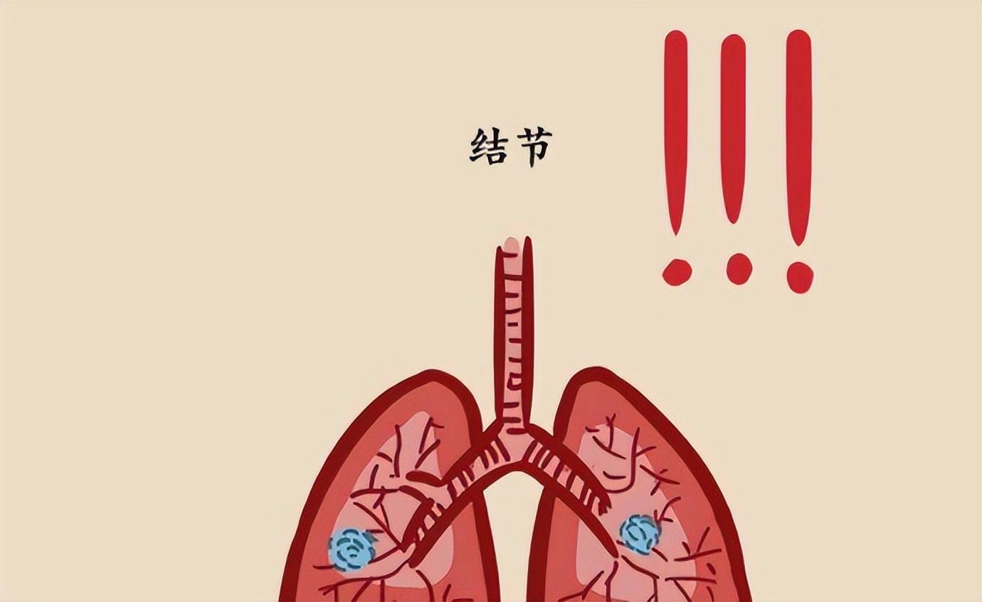 肺结节应注意什么?_生活_病情_症状