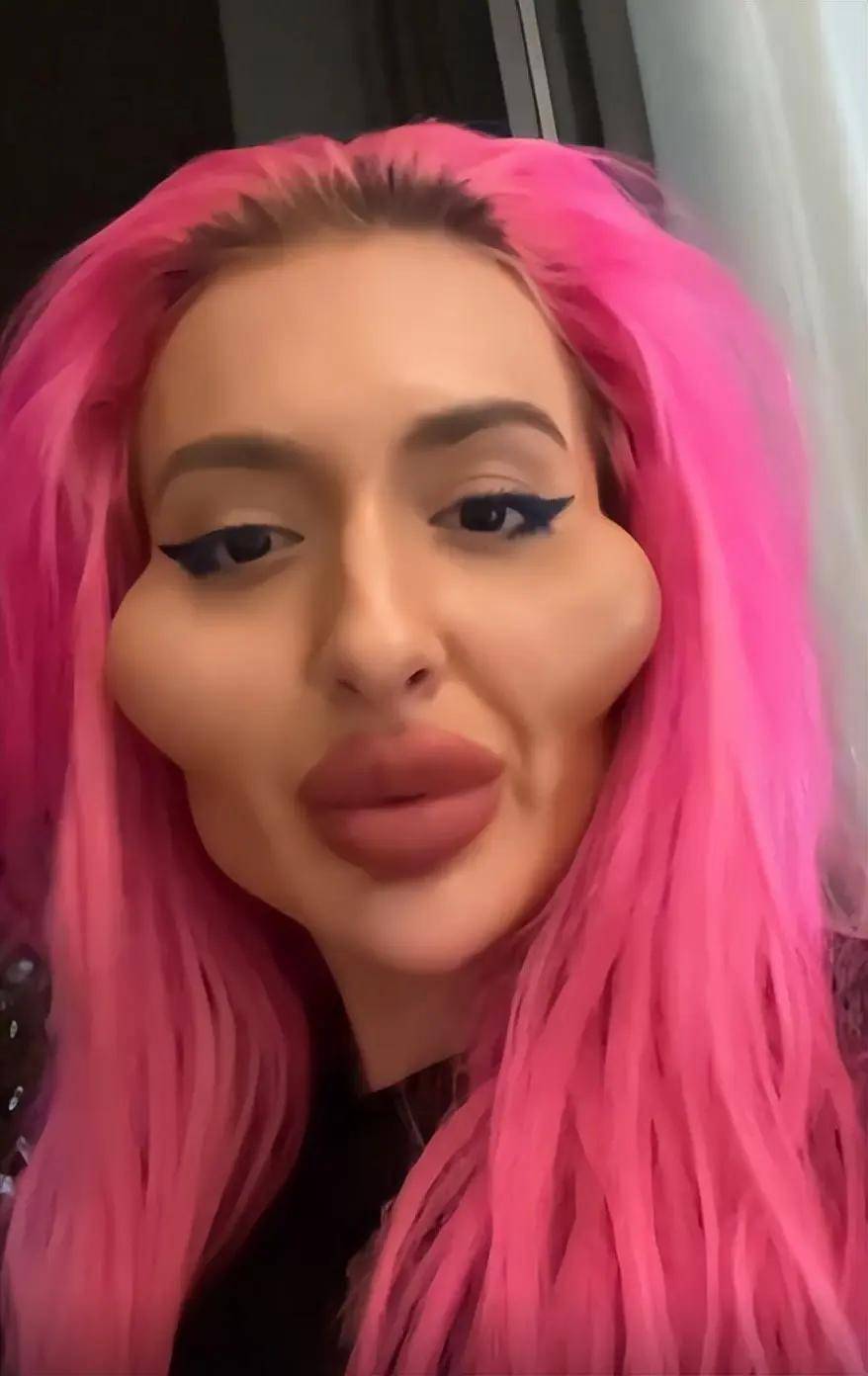 原先颧骨完全不突出,她号称"拥有世界上最大颧骨的人".