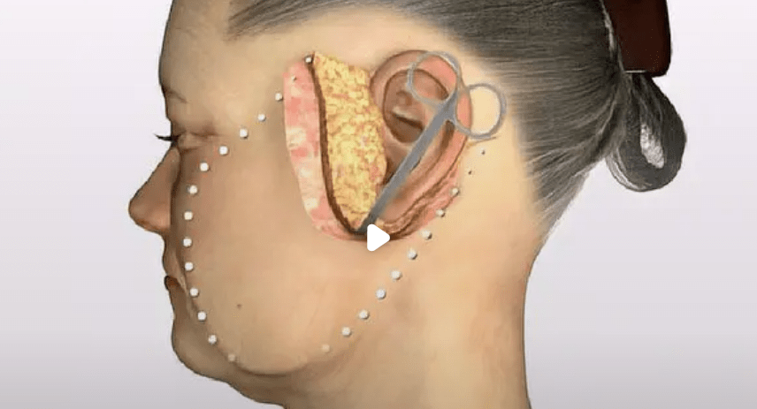 拉皮手术价格一览表揭秘拉皮手术一般多少钱拉皮术除皱价格别踩坑了