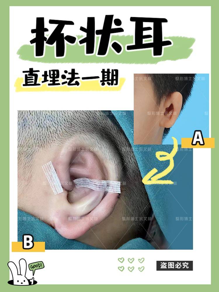 余文林耳部科普杯状耳长大后是什么样子