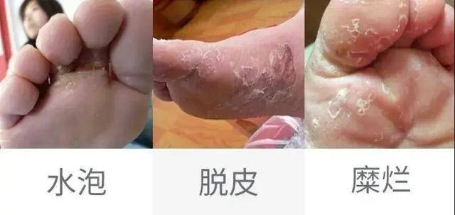 腳氣怎麼治療能除根?專家:這幾個簡單小妙招,28天后雙腳滑嫩!