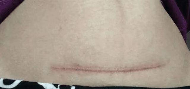 的肚子上有一道很长的疤痕,可刘思佳却表示是在工作时不小心划伤