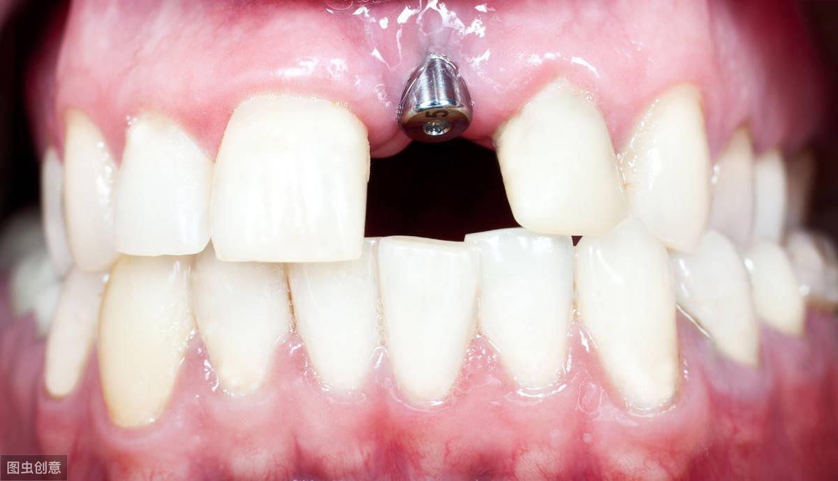 种植牙怎么种进牙龈直接打钢钉不疼吗专业医生告诉你利与弊