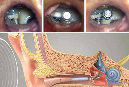 人工听小骨植入的图片图片