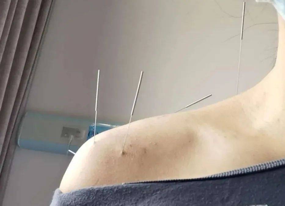 后来,她听邻居说针灸有用,便又去尝试了,做完针灸下来,肩膀感觉热热的