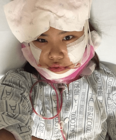 削骨的危害削骨一年后脸塌了削骨后遗症还有救吗