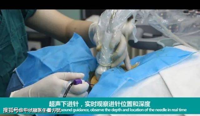 甲状腺结节微波消融术全过程1520分钟不开刀真微创