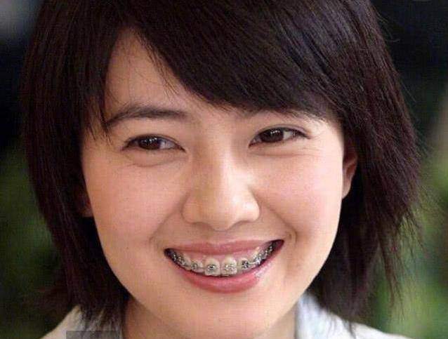 在刚出道时,高圆圆曾经戴过牙套,取下牙套后,高圆圆摇身一变,成了大