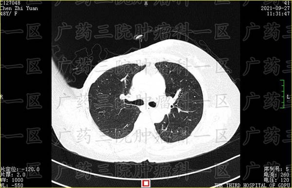 乳腺癌骨转移怎么判断?