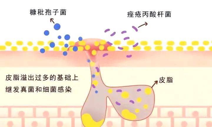 在皮脂溢出过多的基础上,脂溢性皮炎可继发真菌(糠秕孢子菌)和细菌