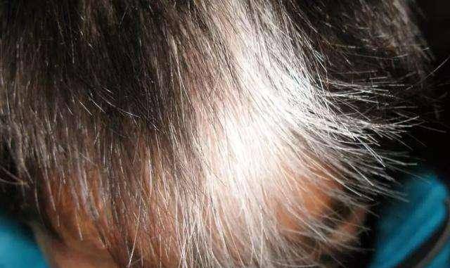 原创             白发长在哪里，病或从哪出？长在前额两鬓和后脑勺，或说明什么？