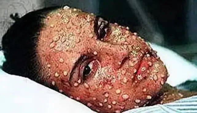 猴痘,人痘,牛痘,水痘,"痘"有啥不同_病例_孩子_疫苗