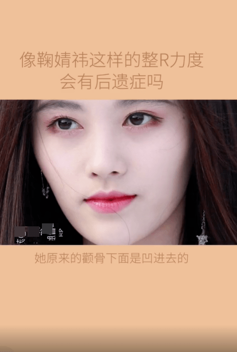 原创网红吐槽鞠婧祎出现整容后遗症如果继续填充会有蔡明奶奶的味道