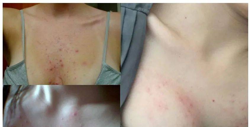 这也是为什么很多女生一到夏天胸前就发痒,长痘痘,痱子,湿疹.的原因.
