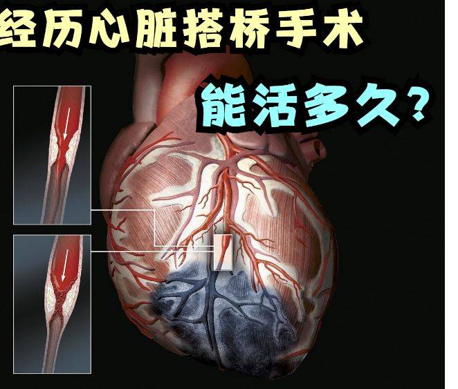 心脏搭桥真实图片图片