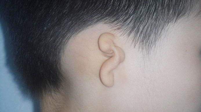 我国每年新增先天性小耳畸形的患者在3000