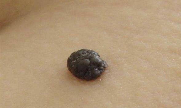 皮肤上长多余的小肉球是癌变吗会传染吗