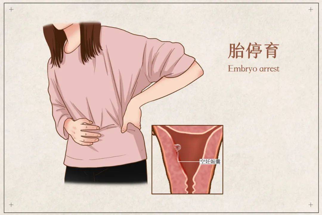 胚胎停育是怎么回事