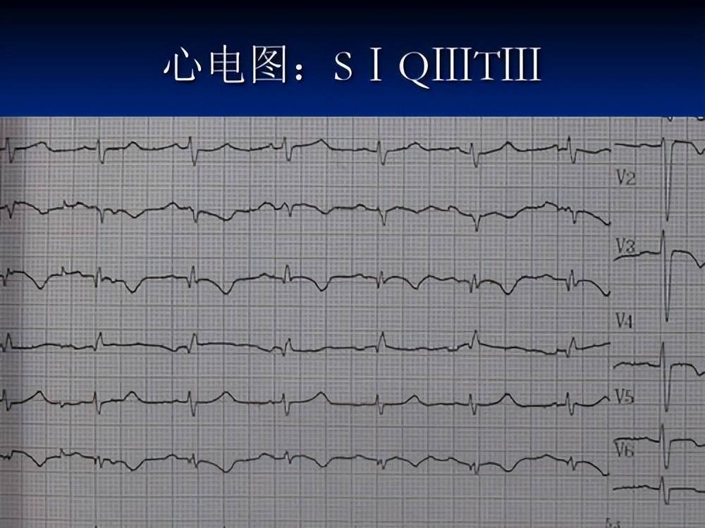 肺栓塞的心电图s1q3t3图片