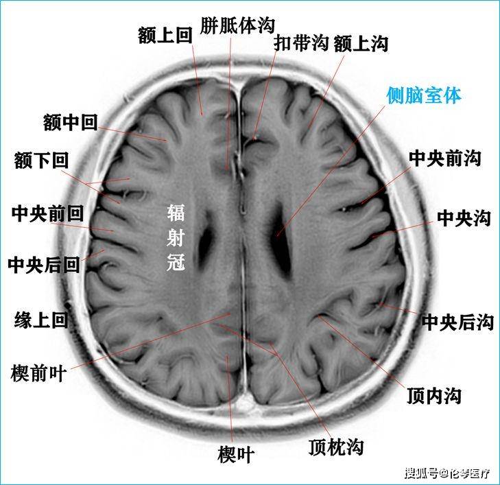 核磁头颅解剖图图片