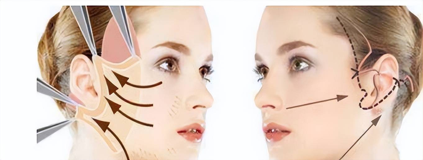 面部拉皮如何快速消肿修复?知道真相的我哭了~_皮肤_损伤_局部