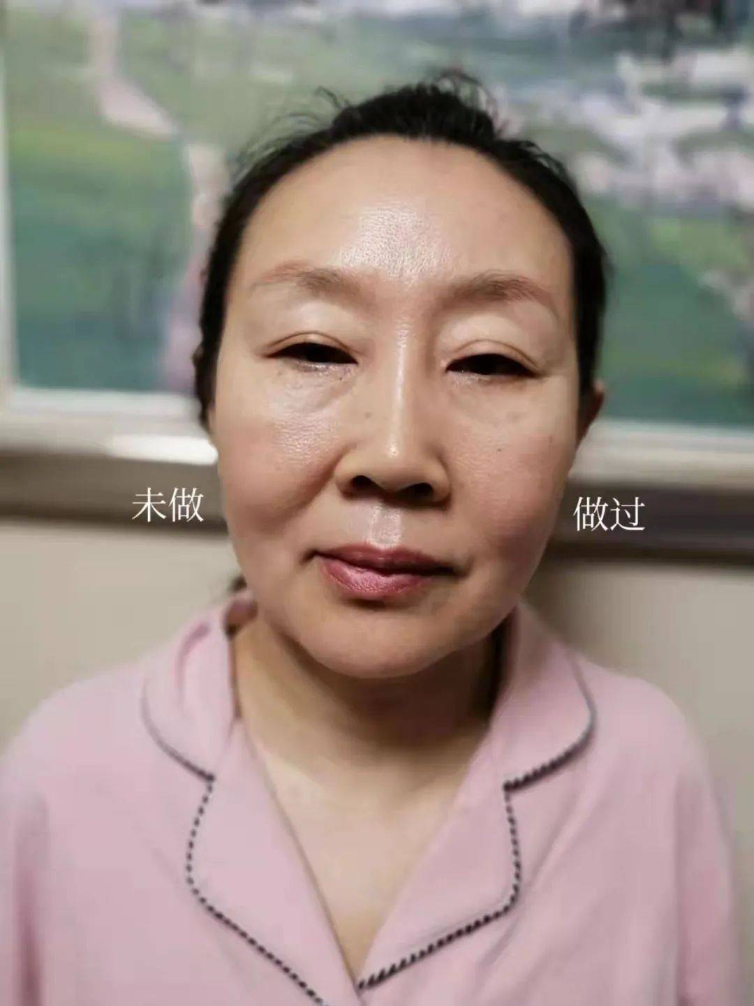 刘力萍面部针雕美容一针瘦脸去皱隆鼻面部提升一针瘦肚子