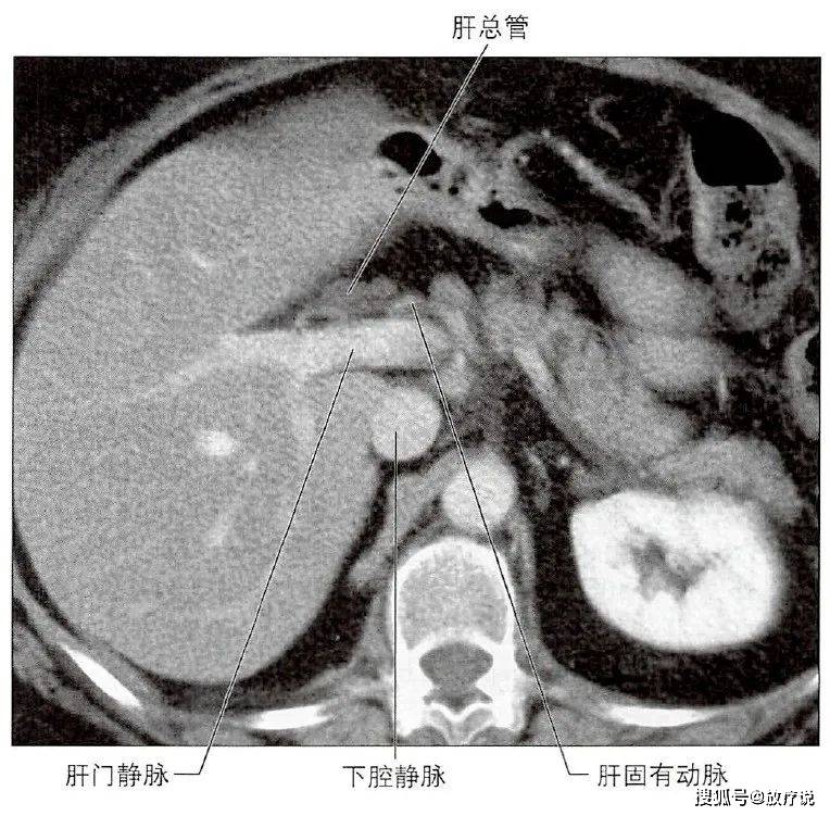肝脏及肝门解剖图谱，今天它来了！_静脉_分支_结构
