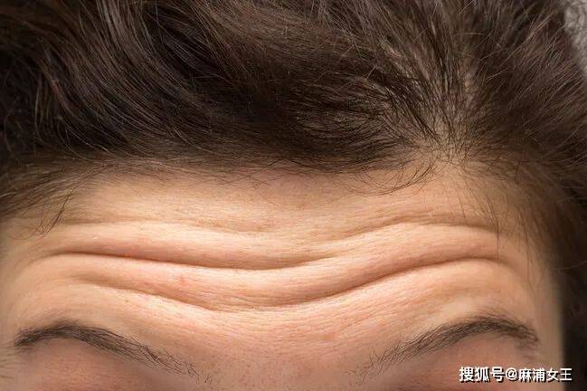 如果不做表情时,额头上能看见明显的线条纹路,那就是真性抬头纹了